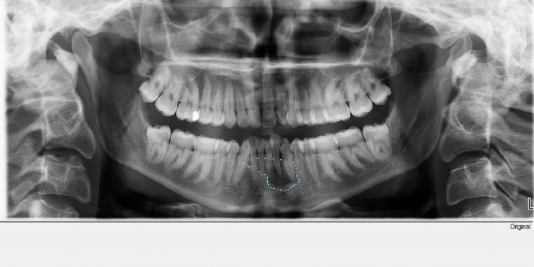 Radiograph of a focal abscess in the anterior mandible