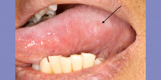 Patient exposing side of tongue showing a lesion